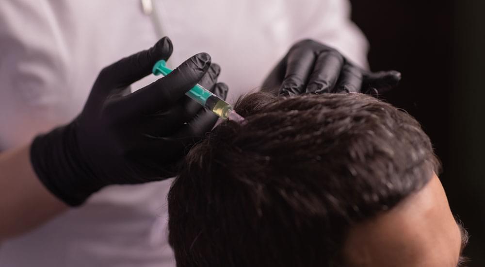 saç mezoterapisi nasıl yapılır